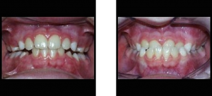 Before and after comparison of Phase I treatment